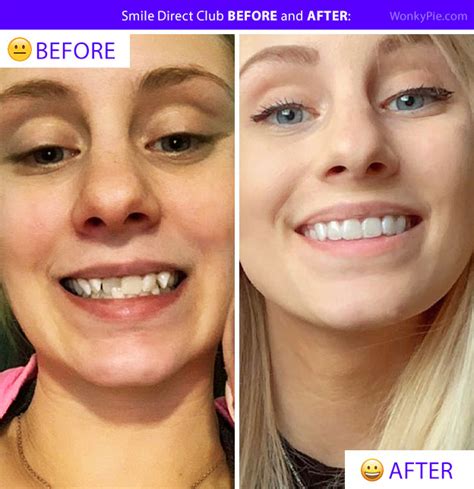 smile direct before and after.